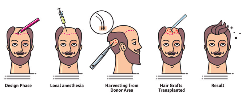 FUE Hair Transplant – The Wellness Clinic Aesthetics