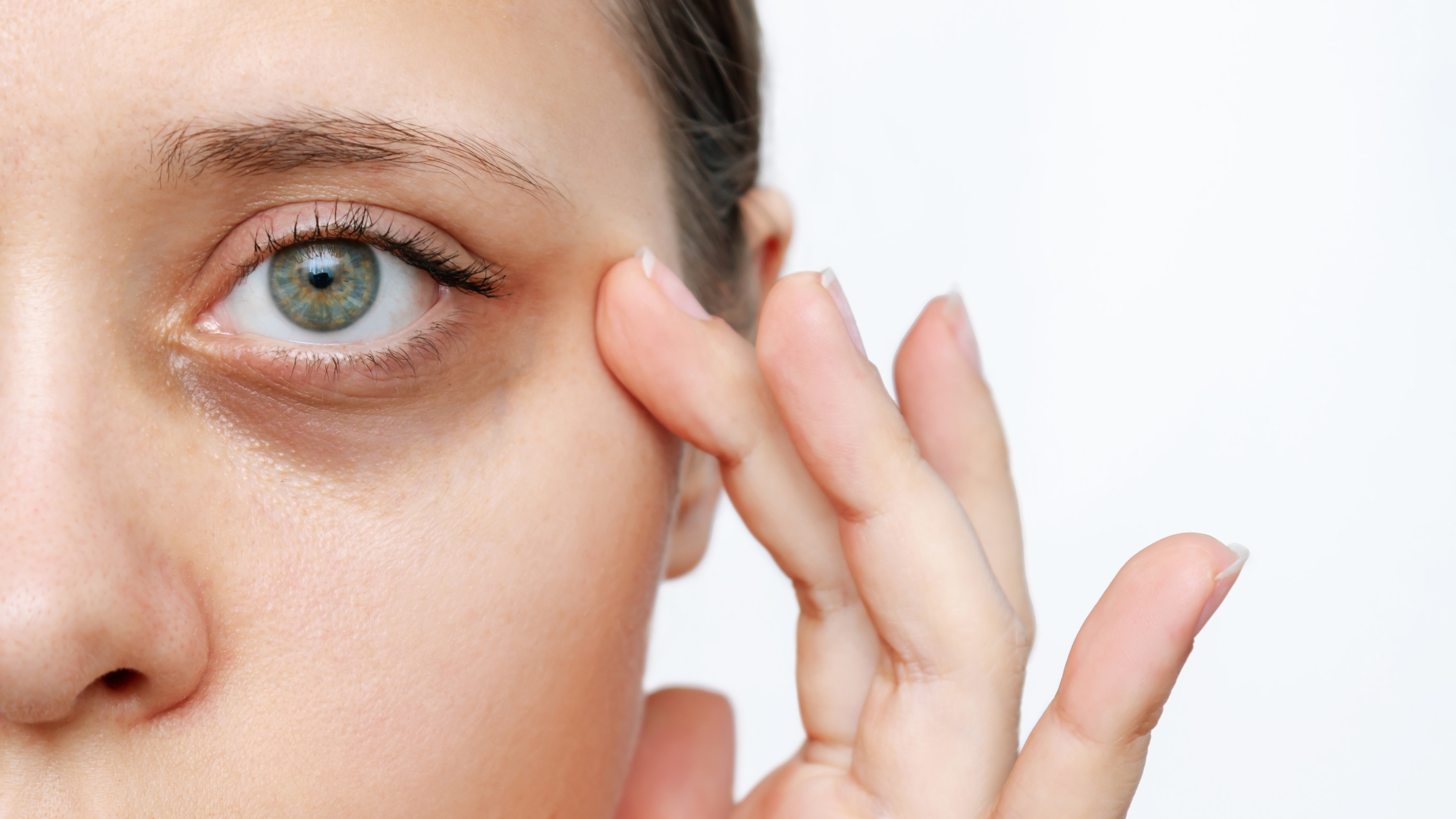 Dark Eye Circles - The Wellness Clinic Aesthetics